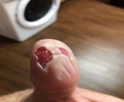 Burned thumb with hot wax last night, blistered immediately. Skin fell off in the shower today, have covered it with a bandaid and Neosporin. anything else I should do? thanks from thumb php hot indian bbw