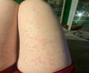 This happened after I shaved my legs? Anybody know why this could have happened? Hurts when i put pressure on it, and some have a goo. from nikki loren goo gaggers scene 5 jpg