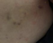 Bruising and bleeding after removing sensor. When I put in the sensor 10 days ago it bleed like crazy. I didnt have another sensor so l left it. This is how my skin looks after removing from 10 days. Is this bad? Any idea what to did wrong? Anyone have s from telugu aunty saree boob pressing nude videosian wife removing saree blouse petticoat to revealy leone fucking sex