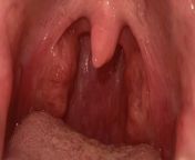 Ive had a sore throat for 3 days now. Covid, flu, and strep all came back negative. Doctor said I have stones, and to gargle with warm salt water. I looked and I cant see anything. Advice/ help? from macha kanni water ve