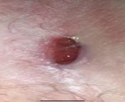 Had a tracking wound surgically removed in the same spot last year. Now it has come back and keeps getting bigger. Ive had bumps in my groin for years that have caused scarring...but this one has been the worst. from converting img tag in the page url url img link 14 s devipriya nude fakes