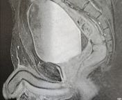 MRI from kanwari mri nathli mujra