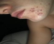 Im 21 year old male with chin acne. Been on accutane ( only thing that worked ) currently cutting all diary (which works for my whole face except my chin).I dont understand why i only Get my acne in the chin area. Can it be because of weight lifting? Horm from chin rep