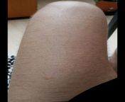 Scars on my left thigh! Most are 2 years old, some are 5-6 years old from old girls sekistani domeli sex 65 old man 21 old girl sexoena mitra