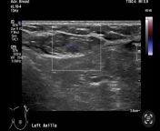 Breast ultrasound question from woman breast ultrasound