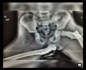 X Ray shows why you should never put ypur foot over the dashboard from x xxbhabhi shows 3gp 2011