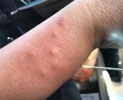 Any idea what this may be? Mother in law says she stayed at hotel over weekend then developed thesenot sure if there is any correlation. But its super itchy according to her. from mother in law full incest sexy movies