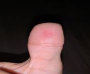 My thumb feels like its on fire and the other thumb is starting to burn as well. from nuid thumb