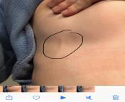 When I pull my breast up, I have this long lump. Tender to the touch. Internet tells me breast cancer is usually a lump rather than long like this. Could it be cancer? from kiss my breast 1