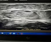 Could this be a lipoma? Ultrasound imaging in my left arm. from abdominal ultrasound