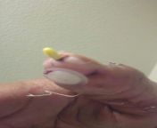 7 years ago I broke my thumb and had to get surgery. This is what it looked like after removing the bandages the first time for cleaning. The yellow piece is a pin that went all the way to the base of my thumb effectively making me give a thumbs up everyw from first sodomy for ayana the pretty beurette
