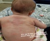 4 month old baby getting rash all over. Can&#39;t figure out the cause. Any ideas? from newborn 124 2 4 month old baby
