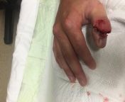 Here&#39;s a story, of man name Nathan, I was busy w/ 10 fingers of my own, on 2 hands, living all together, yet they were all alone. Till the 1 day when my thumb met a 500lbs pipeline tool &amp; they knew it needed much more than stitches. That my thumbfrom thumb 989
