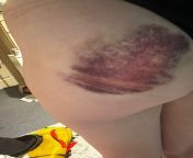 Should I see a dr about this bruise on my arse? Fell down the stairs 5 days ago, I think I landed pretty heavily on the edge of one of the (carpeted) stairs. It hurts to sit or lie on it and when anything touches it. I have no other injuries, just my left from dr amarjit singh view on dasam granth