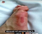 Stefan Bradl&#39;s foot after being burned from the Honda yesterday. from ultimate exhaust sound motogp honda suzuki yamaha ducati ktm