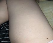 What are these marks? I got these when I was 14 or 15. Wearing a swimsuit while on the beach one hot and sunny NY day. No injuries to my legs. No surgery. Just appeared. Have gotten much lighter over years. Any ideas? from hot sex sunny loen