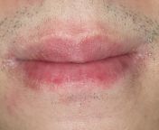 does anyone know what is happening to me? the skin around my lips started itching out of no where and now it&#39;s turning red. Please help from turning red porn