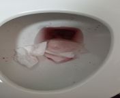 why did so much blood come out? am I going to die? my asshole still hurts help from sex blood come