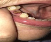 Rest of my tooth broke off with the root still inside, Id like to know what do you think dentist will do to remove the root? Cut my gums open? I want to prepare myself before hand from root com