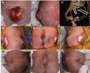 A case of myelomeningocele in a baby born at 38 weeks from baby born woman com