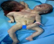 Conjoined twin girls who died during birth from twin girls