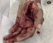 Rich the Kid slices hand open in UTV accident. NSFW/NSWL from utv binass