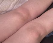 Hot swollen red knees. No pain, but the heartbeat feeling is uncomfortable. I have been tested for lyme and arthritis, but doctors dont know what it is. It comes and goes. from birth hot swollen