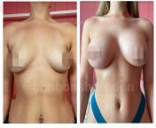 Before/After Boob Job (My Pic, Watermark is Twitter Username!) from pic twispike twitter