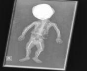 Forensic fetal Xray (Post mortem) - screening for skeletal anomalies (there are none) from girl post mortem sexw pakistani young
