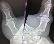 Old torn RCL ligament in left thumb xray from actres nayantara xray nude