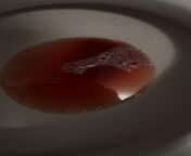 Bloody urine after rough sex from www hijira urine pass karnataka sex videos