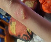 Yall i know its a burn but im curious about why it causes a white area in the middle where the blisters appear. Is that where it hit the dermis? Dont worry its already been cleaned and moisturized im just curious about this. from curious maids become slaves being for curious
