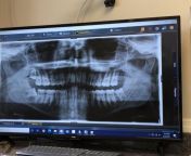 (X-Ray) Im missing a tooth in the top right corner. Doctor says theres roughly a 5% chance someone is missing or has extra wisdom teeth from tamil aunty raasi nude x ray i