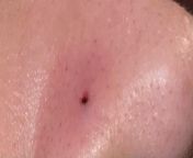Took my 4 day old nose piercing out yesterday as it wasnt right for me but the hole looks.. awful? Its filled with black (blood?) Is it normal? from ayesha thai sexan lades nose piercing