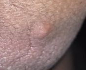 Is this a wart or related to HIV. Should I worry about it? I just noticed it yesterday. Its painful when I squeeze it. from hiv