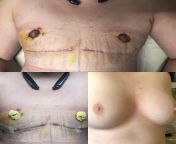 **NSFW** Dr. Rednam, from Houston, Texas, did an outstanding job and couldnt be more happy with my results. Surgery was performed 8/12 at 10am, pain has been minimal and have still been able to do basic things like go to the grocery store, put to each, b from basic minimal css