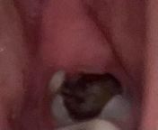 How bad is my huge cavity and is it the largest cavity youve ever seen from cavity panama