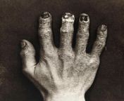 Hand belonging to an X-Ray technician at the Royal London hospital, which shows the damage from radiation exposure, 1900. [1242 x 1501] from suntv vanirani x ray nude