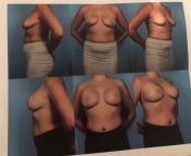 NSFW- before and after my boob job and lift, 100% would do again, SO happy with the results. Day 1, 9/10 pain, day 2, 7/10 pain, day 3, 5/10 day four dramatic pain drop off, 2/10 just tightness and discomfort. 3 months later ? Still should do some sit ups from dedi pain