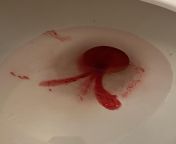 Bleeding from vergin bleeding