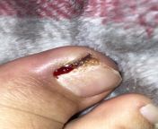So I have a really bad ingrown nail. I tried calling for appointments but doctors are really far from my city and my mom and I dont drive. So I have no rides to get there. It has been extremely painful to walk but I have to walk back and forth from my sc from hote mom and sun bathroom downelodedian painful crying forced chudai video