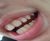 Am I suffering from and gum recession in this picture, I know I have some gum inflammation but I went to the dentist a week ago telling me I do not have gum recession, just a little worried, seeing the dentist again in May. from gum sq