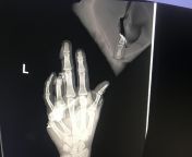Hand vs table saw. Paramedic here this is of a pt that came to the ER I work at. from chota bheem aur krishna ln rish of kirmada pt