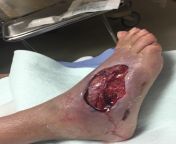 [50/50] a flesh eating infection on a foot (NSFW) &#124; a man pulling his dogs in a train from lauren dewynter pulling a train