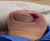 [50/50] A beautiful head of a 3 hour old baby (SFW) &#124; An open toe after a piece of infected toe has been cut away (NSFW) from hour sex baby xxx c