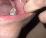 Help? Anyone have any idea what this new little flap of gum might be. Its next to a tooth with no root and where a wisdom tooth has already been removed. from tooth @