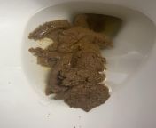 Diarrhea from diarrhea panty