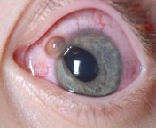 A prolapse of the iris through an open globe defect in the cornea. This represents extrusion of globe contents, and signifies an open globe injury. from open kinnar jtra in puddy