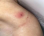 [skin concern] noticed this bump this morning on my shoulder. I put BP and a hydrocolloid bandage but now it was too painful so I removed it. Now there is a black dot and it has an increasing pain. Cant squeeze it. Can I still put BP? Does it need medica from indian gairl bp 3gpridevi sex bp