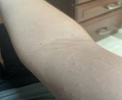 Son (12) woke up with small bumps covering arms and some on torso. from mom son kitchen van sex with small boy 3gp